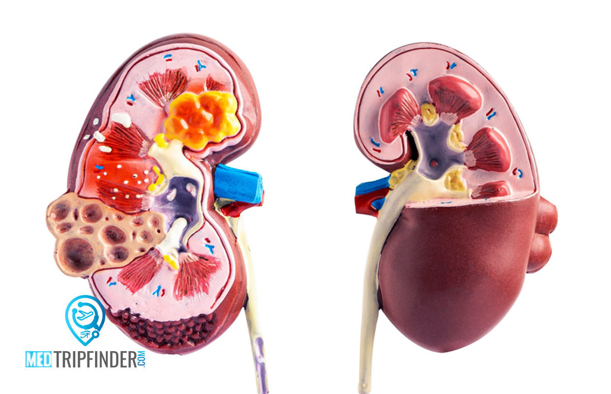 علاج-امراض-الكلي