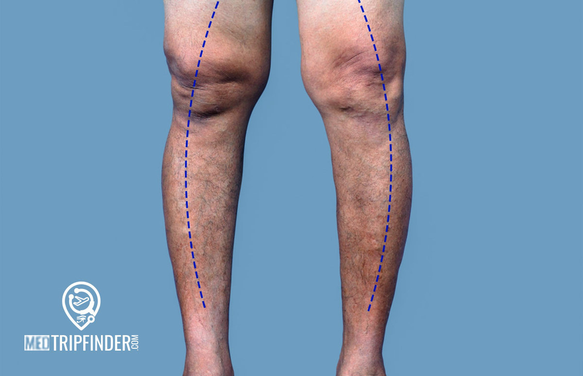 علاج-تقوس-الساقين